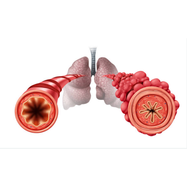 
Diacetyl & Popcorn Lung