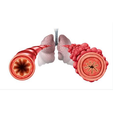 Diacetyl & Popcorn Lung